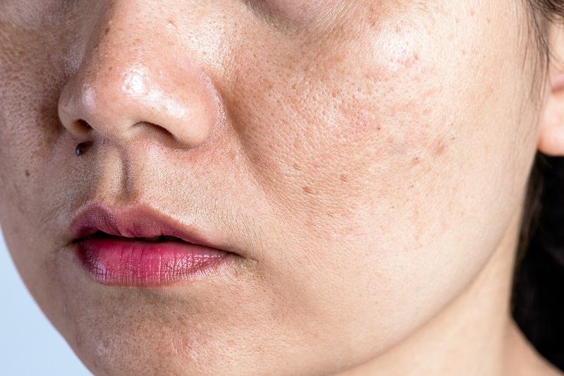 Macchie e discromie della pelle rimedi e beauty routine